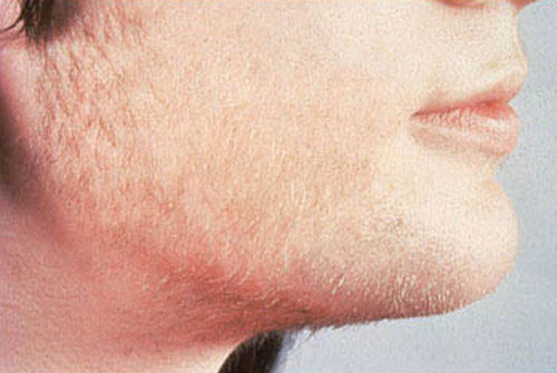 aumento de vello facial síntoma de ovario poliquístico 